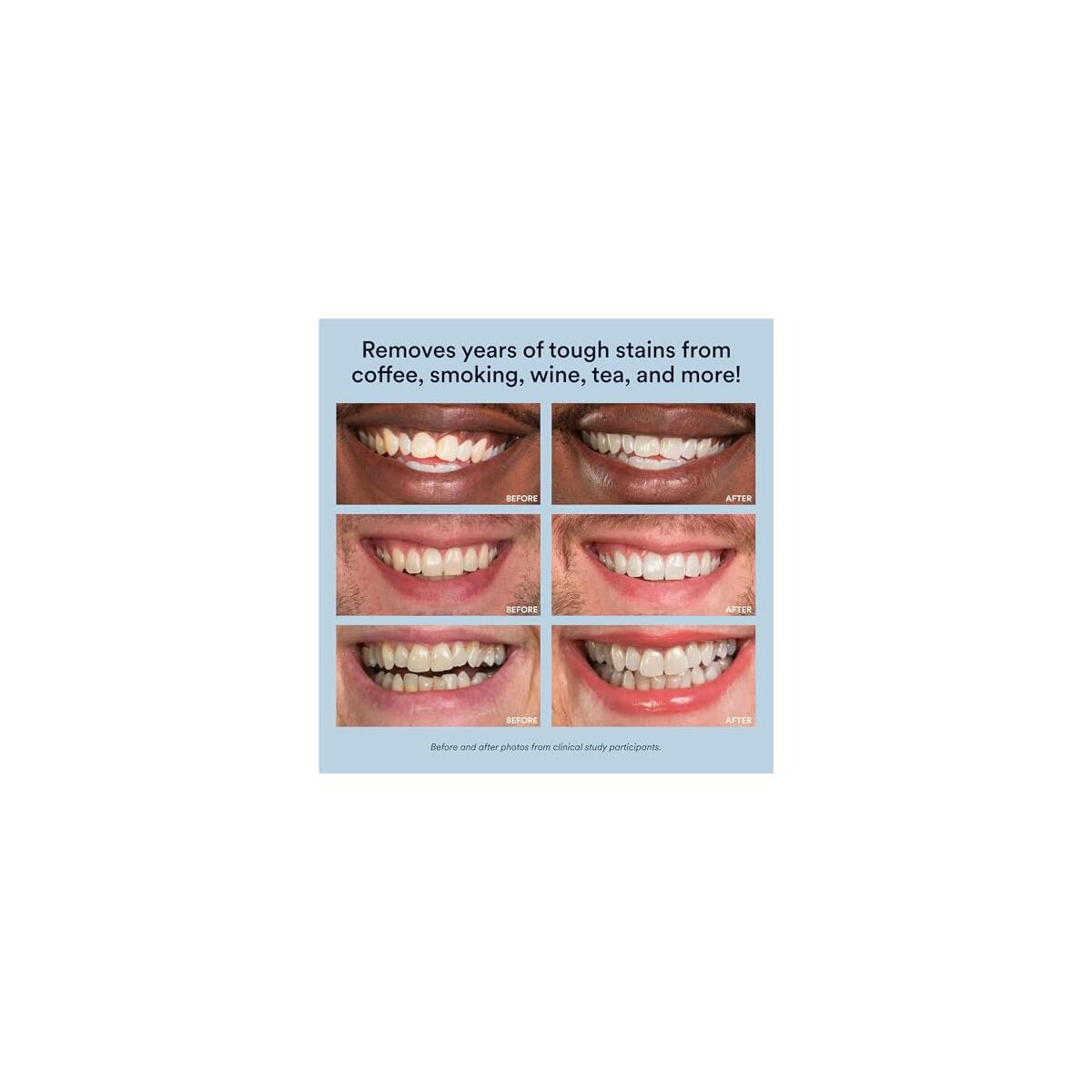 Auraglow Teeth Whitening Kit Deal - RebateKey