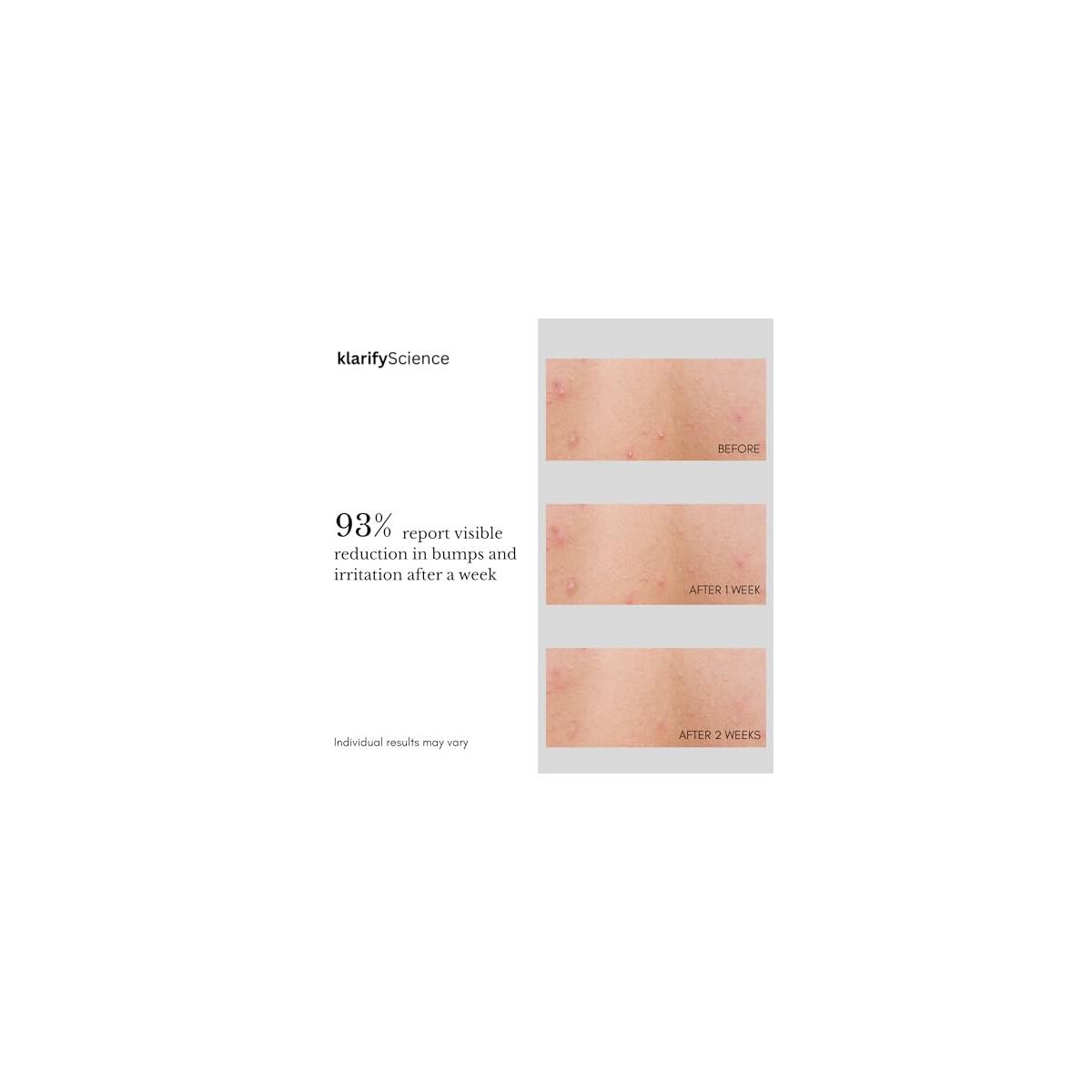 Folliculitis Treatment Cream Cash Back - RebateKey