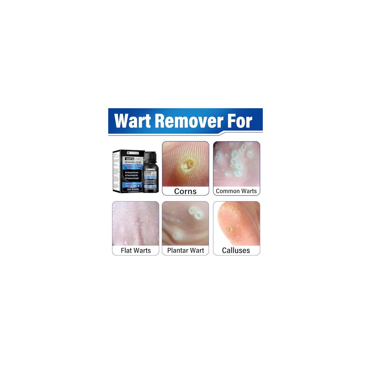 Wart Remover 2 Cash Back - RebateKey