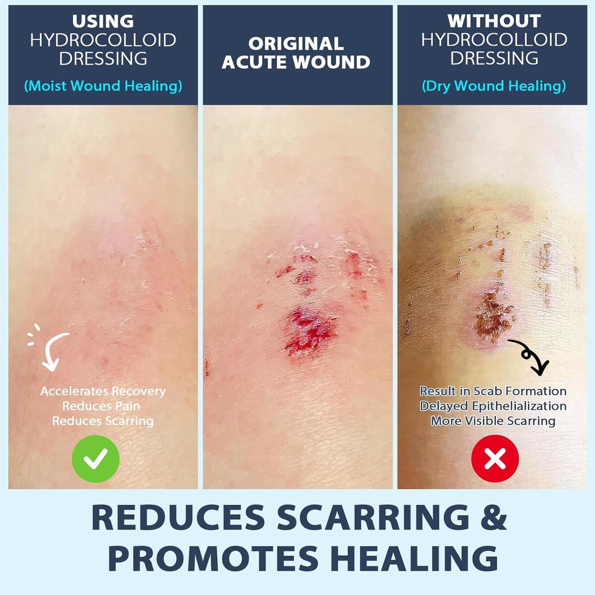 Hydrocolloid Roll Gel Bandages For Wounds 1 Cashback Rebates - RebateKey