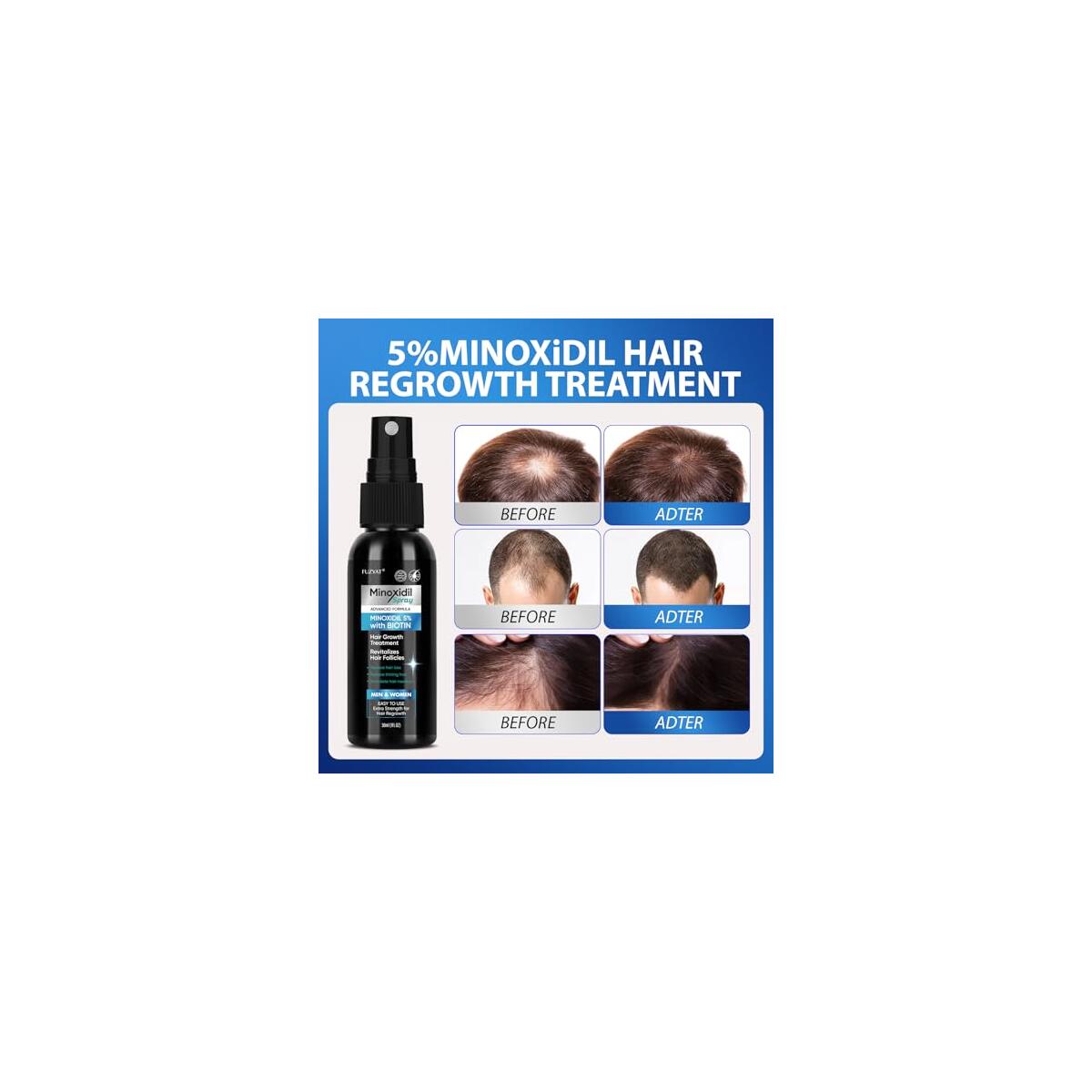 Fuzyat Minoxidil Spray Kit 1 Rebate - RebateKey