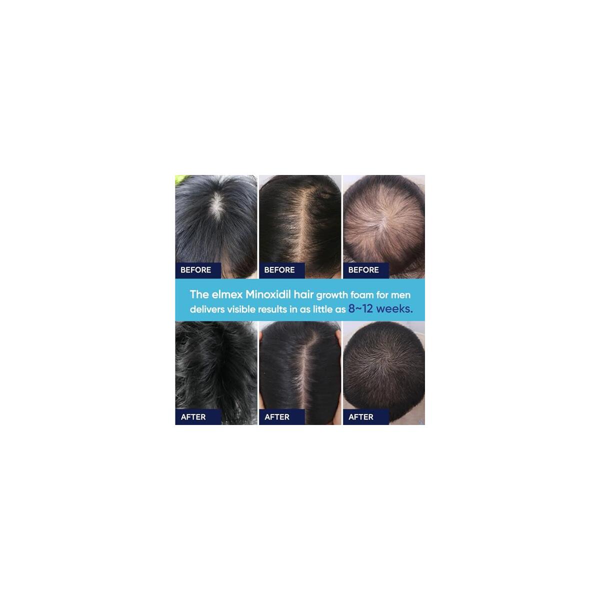 Artimore Minoxidil Foam 2pcs Cash Back - RebateKey