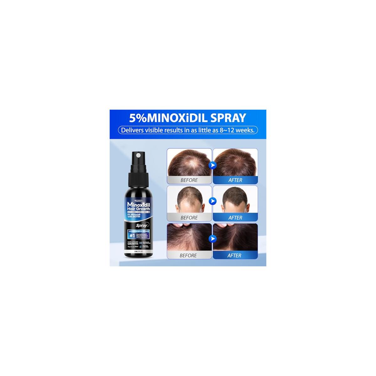 Tuymec Minoxidil Spray Kit 1 Cashback - RebateKey
