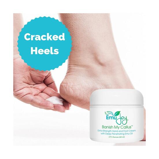 Callus Remover Cream Rebates RebateKey
