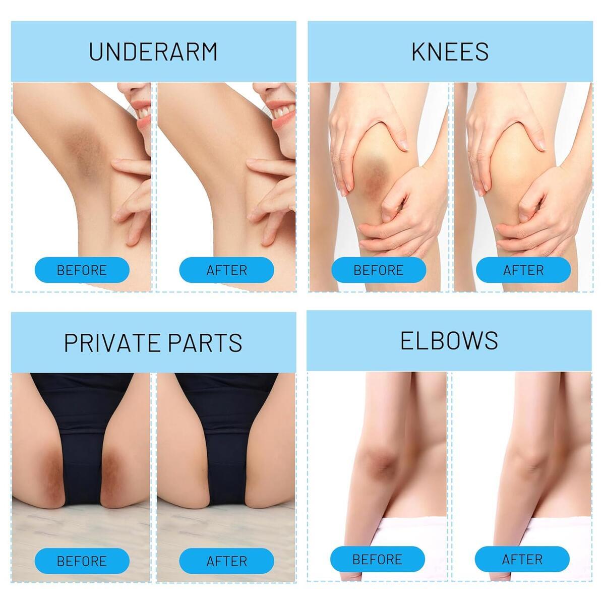 Skin Bleaching Cream 4 Cash Back - RebateKey