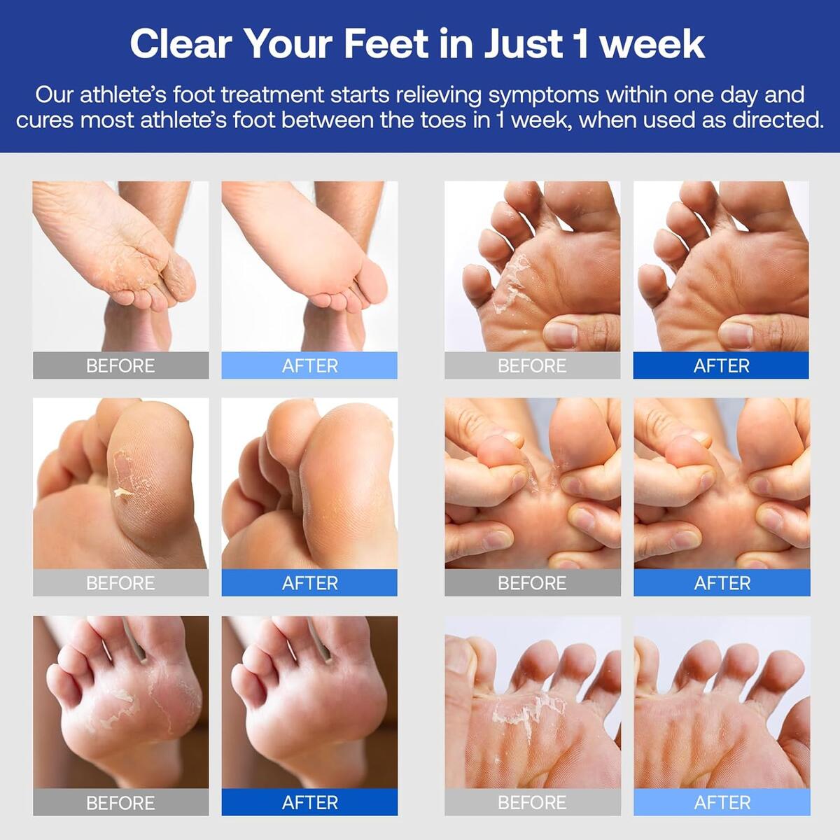 Athletes Foot Antifungal Cash Back - RebateKey