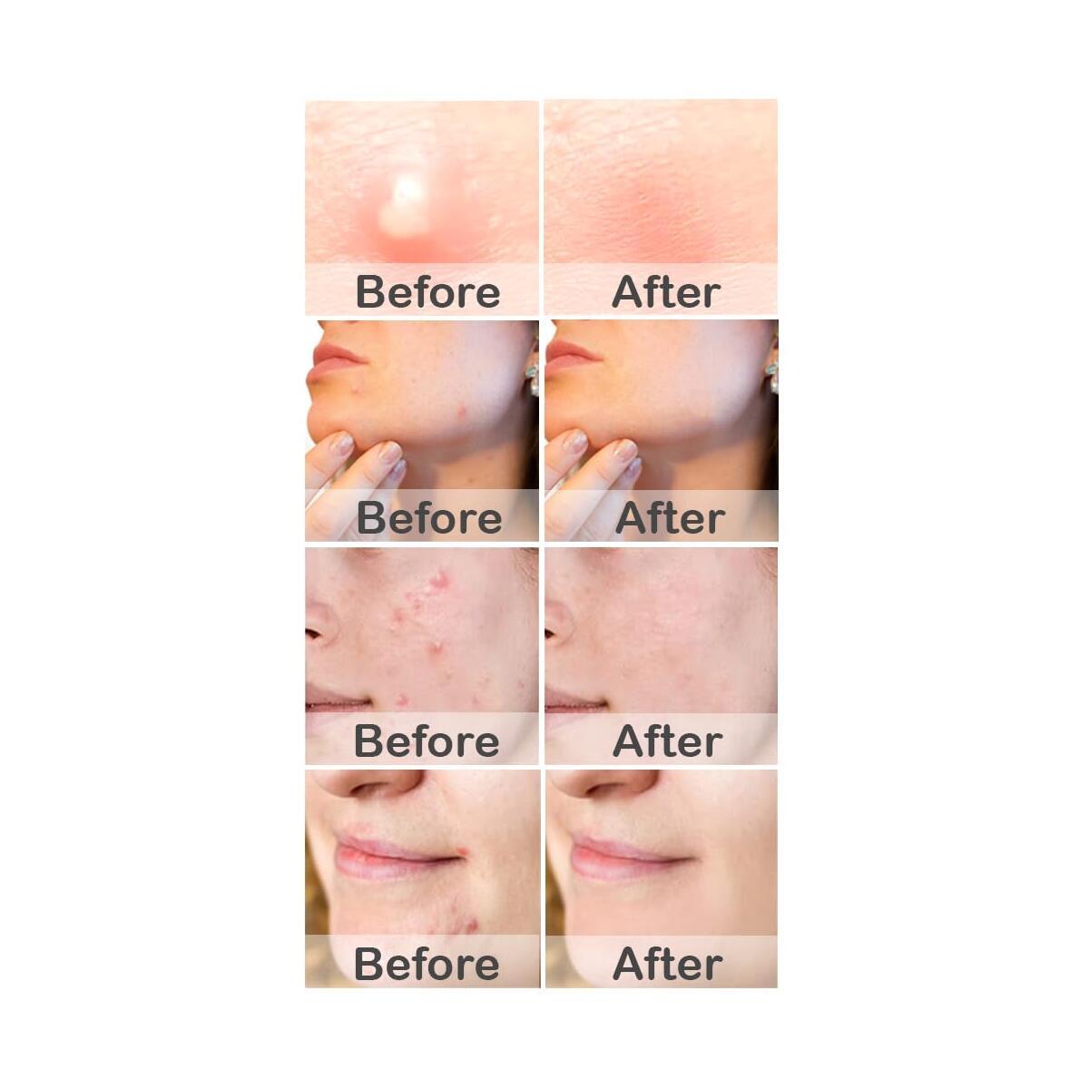 Hydrocolloid Patch Cash Back - RebateKey