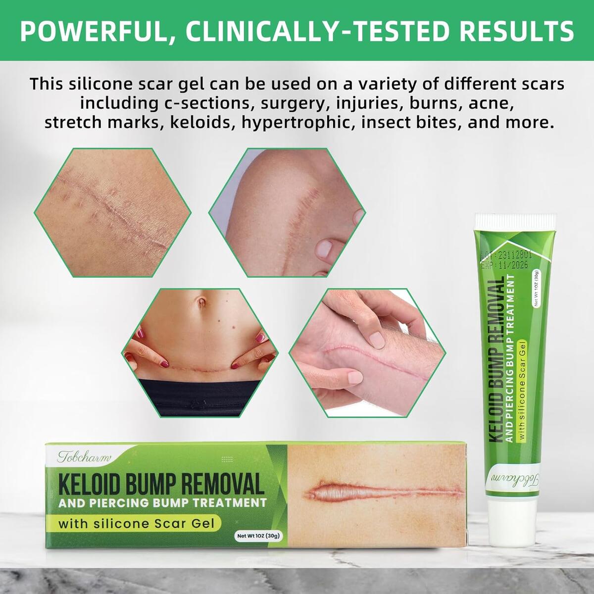 Keloid Bump Removal Cashback Rebates - RebateKey