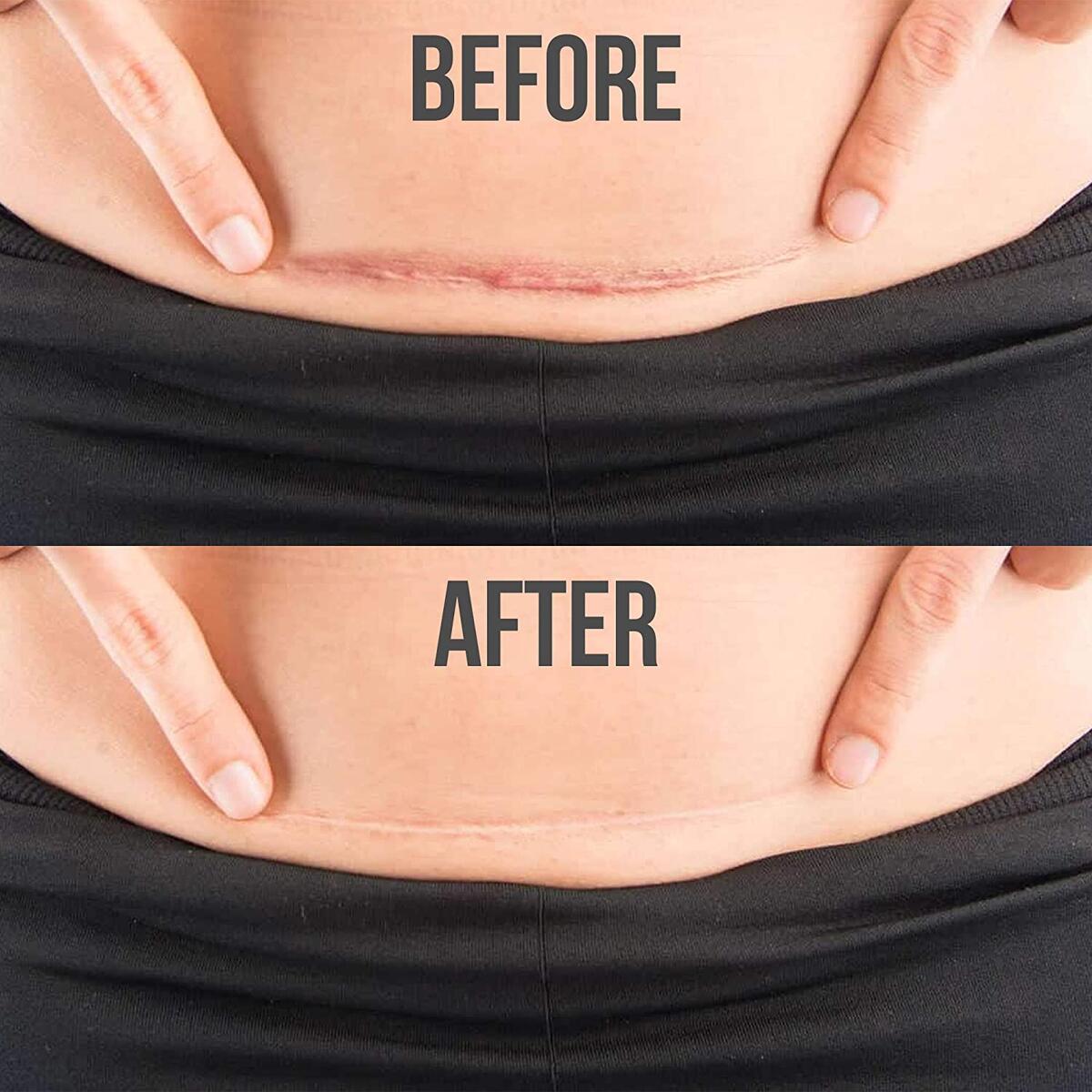 Silicone Scar Gel Rebates - RebateKey