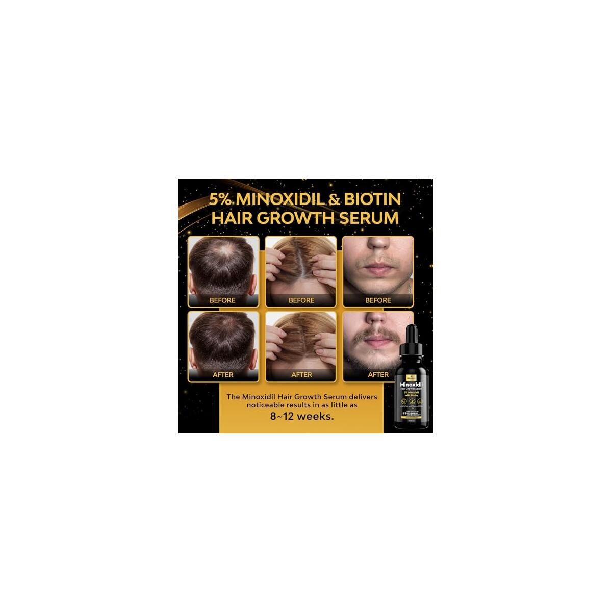 5 Minoxidil Hair Growth Serum Cash Back - RebateKey