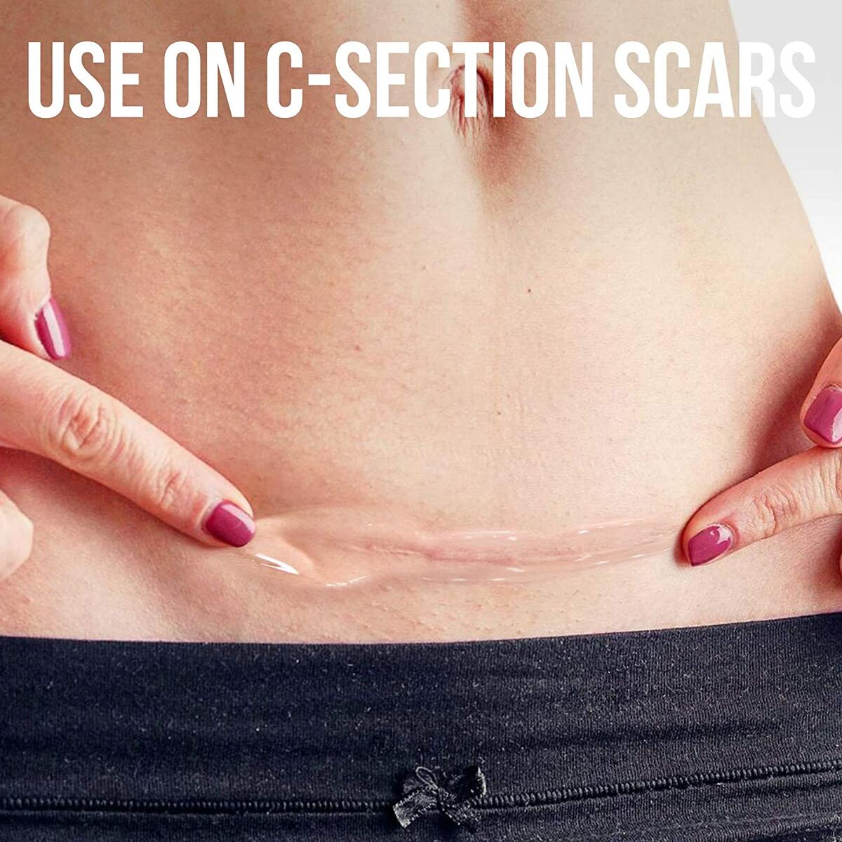 Silicone Scar Gel Rebates - RebateKey