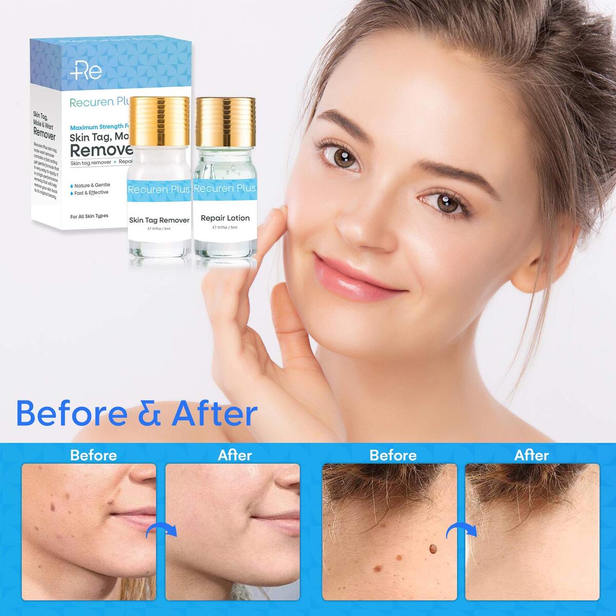 Mole Remover 1 Cashback Rebate - RebateKey