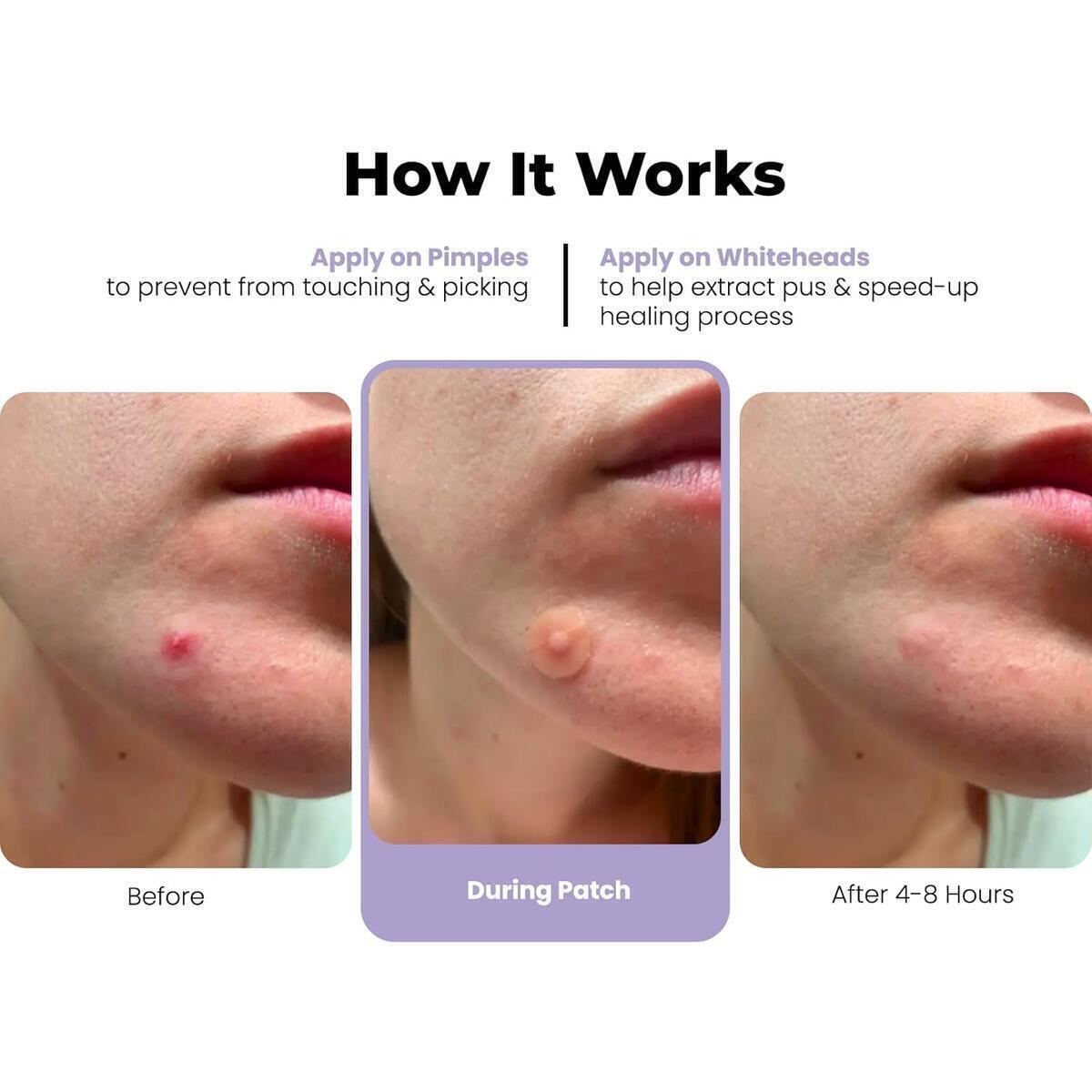 Roselynboutique Pimple Patches 1 Cashback - RebateKey